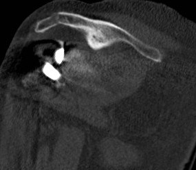 CT Acromial Stress Fracture Reverse TSR